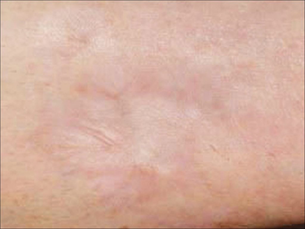Laser semne acnee craiova