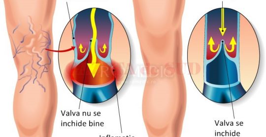 tratamentul medical al extremitailor de jos varicoase