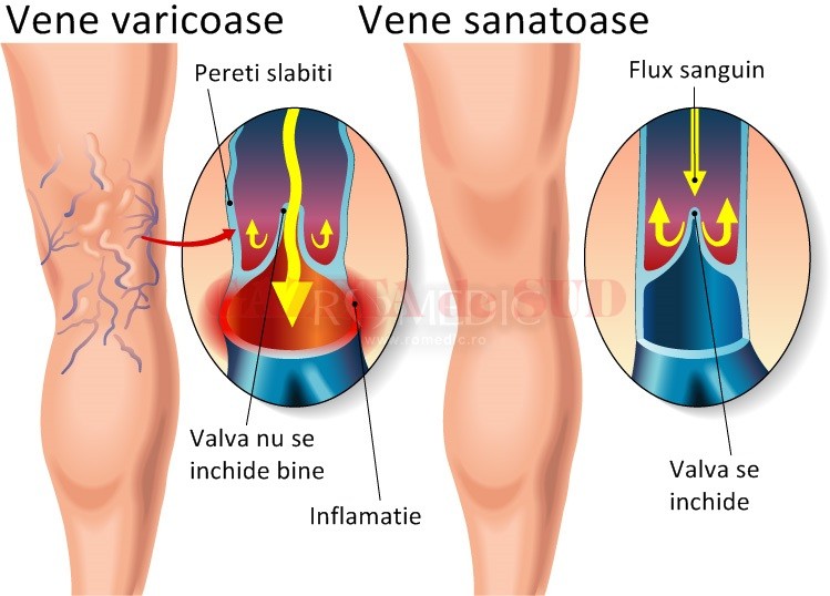 cum se tratează venele și articulațiile durere deasupra spatelui genunchiului