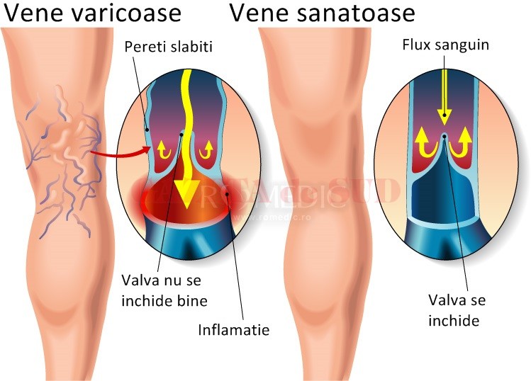 Ce este periculos pentru venele varicoase pe abdomen și cum se tratează vene dilatate