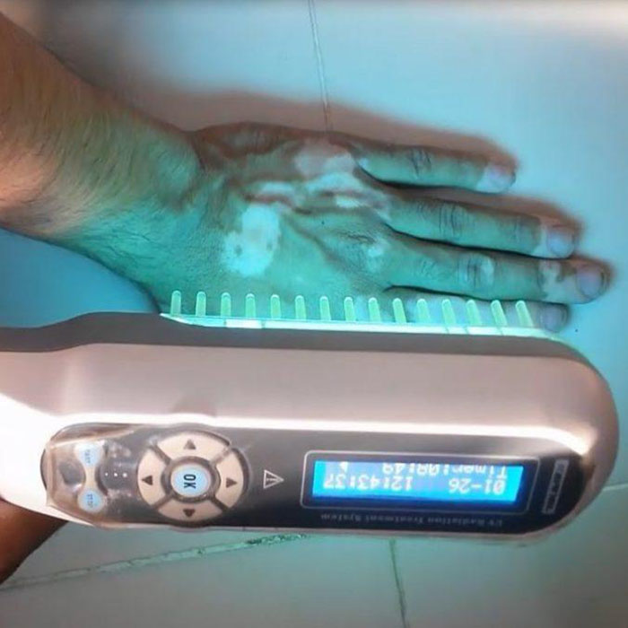 fototerapia-uvb-1